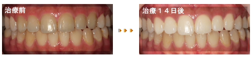 ホワイトニング症例